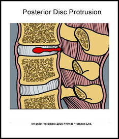 Posterior Disc Herniation and Protrusion