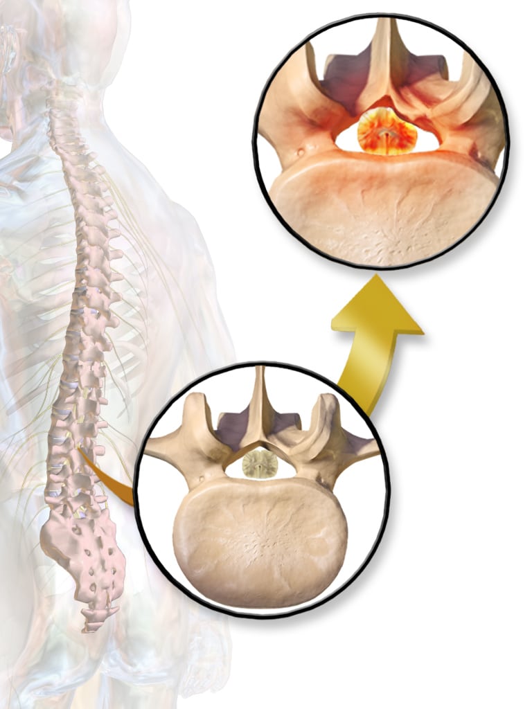 Lumbar Spinal Stenosis