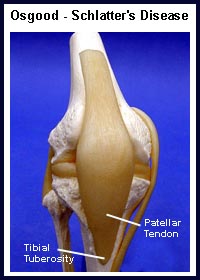 Osgood-Schlatter's Disease