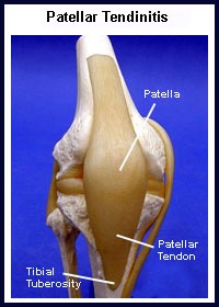 Patellar Tendonitis