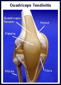 Patellar Tendinitis/Quadriceps Tendinitis - Overview - Mayo Clinic