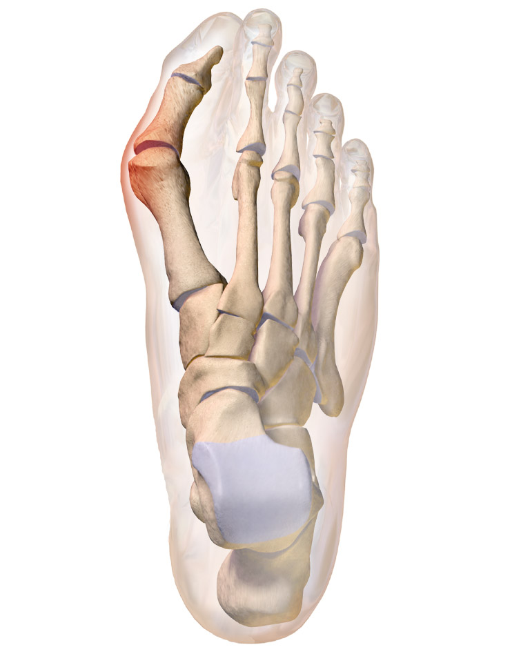 Bunion on the large toe of the right foot