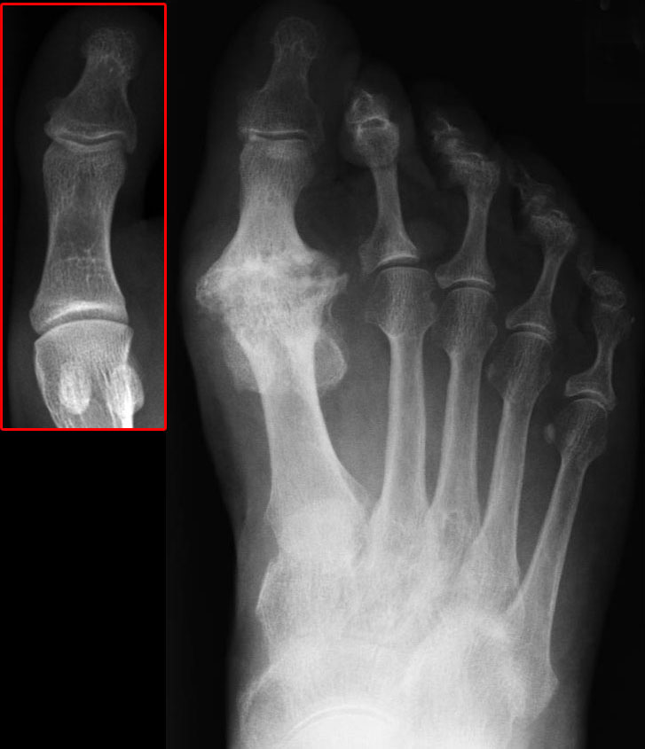 Hallux Rigidus