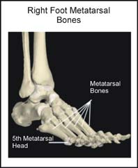 Metatarsal bones of the foot