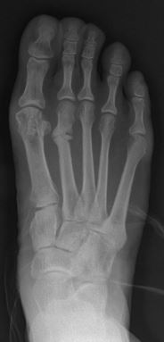 Metatarsal stress fracture - 2nd metatarsal xray